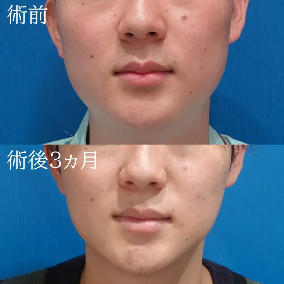 男性のお顔・顎下の脂肪吸引の症例写真2