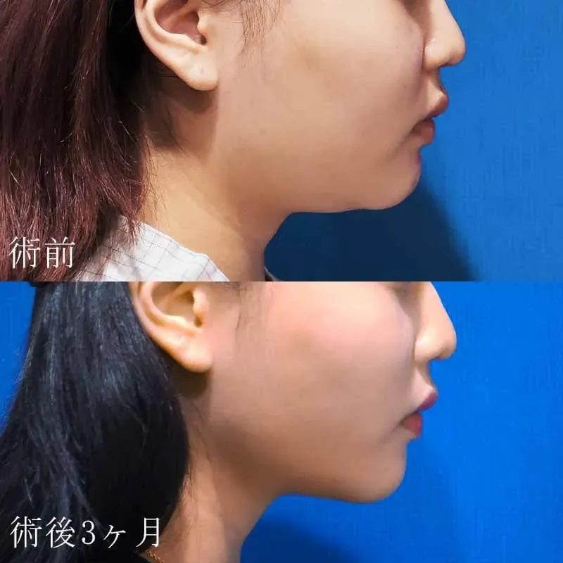 女性のお顔・顎下の脂肪吸引の症例写真1