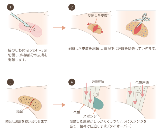 ワキガの手術をしても まだ臭いが気になります どうしてですか 施術部位別の失敗談 美容整形で失敗しないための秘訣 美容整形の失敗と美容外科の裏事情 水の森美容外科