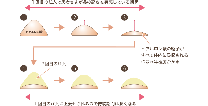 鼻のレディエッセが不自然なので修正したいのですが出来ないのですか 美容整形で失敗しないための秘訣 水の森美容外科