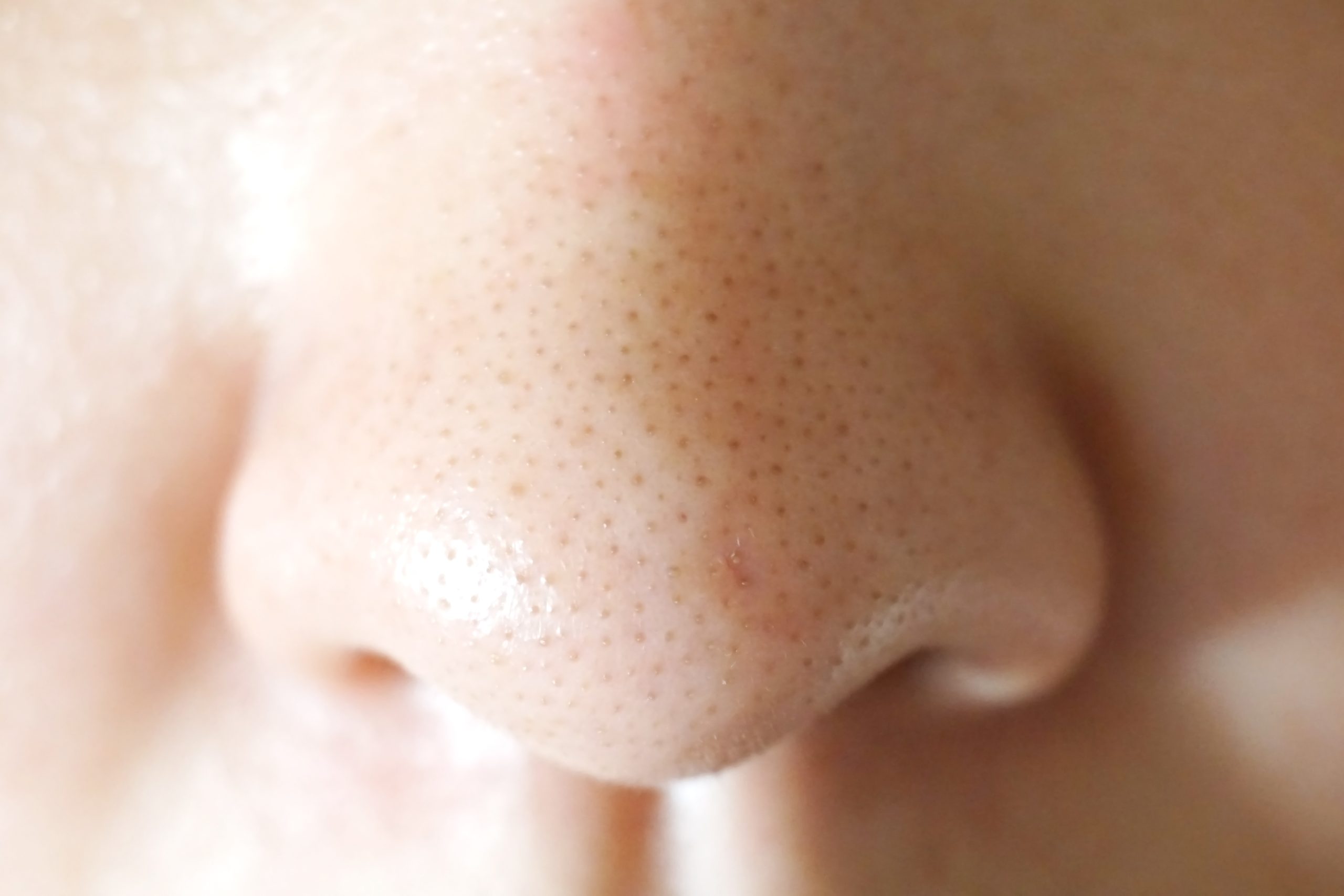 男性のいちご鼻は治せる？特徴・改善方法を解説｜水の森美容クリニック