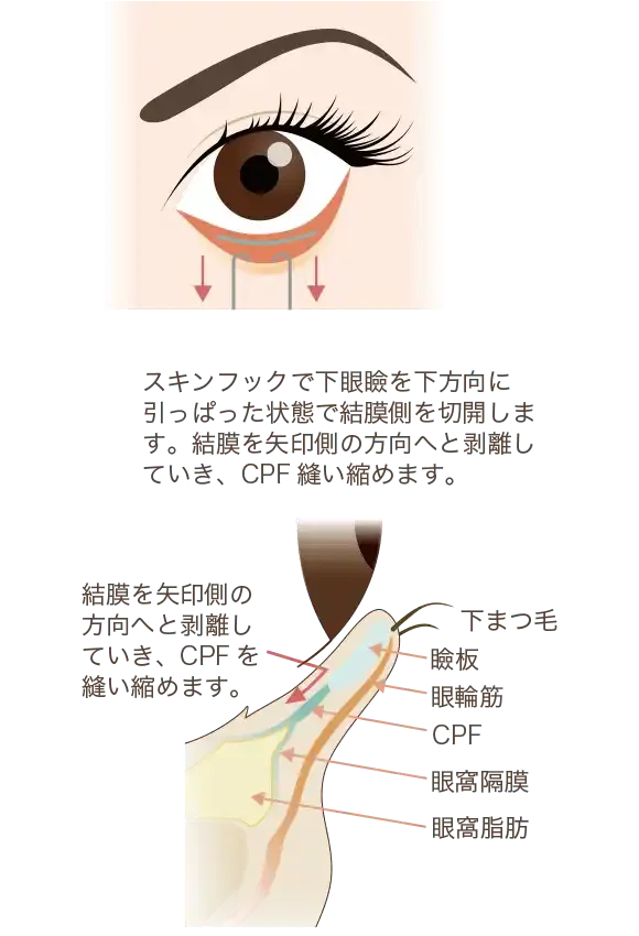 まぶたの裏側からの処理