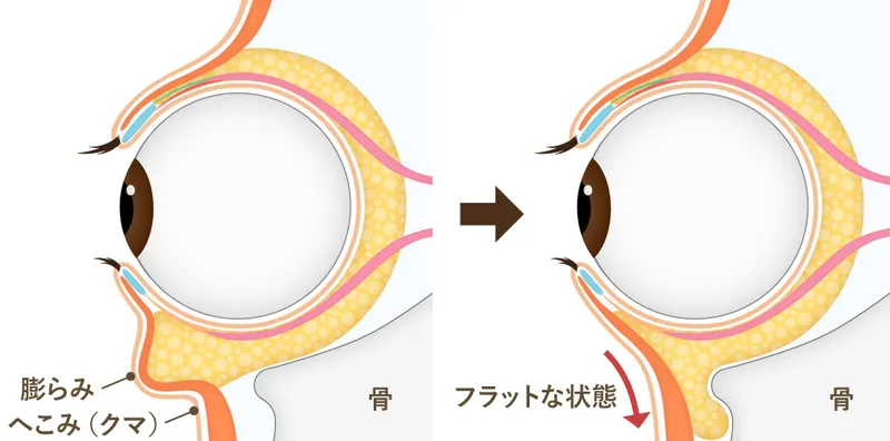 裏ハムラ法の施術について