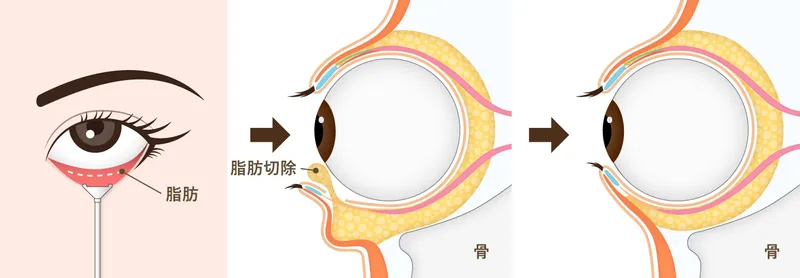 目の下の脂肪取りの仕組み