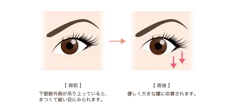 グラマラスライン（たれ目形成）の施術