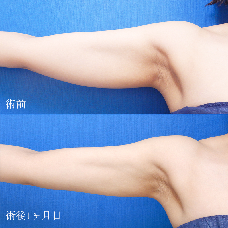 二の腕の脂肪吸引の症例写真①