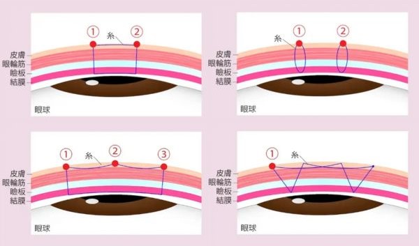 他院様で行われている二重埋没法の糸の掛け方の例