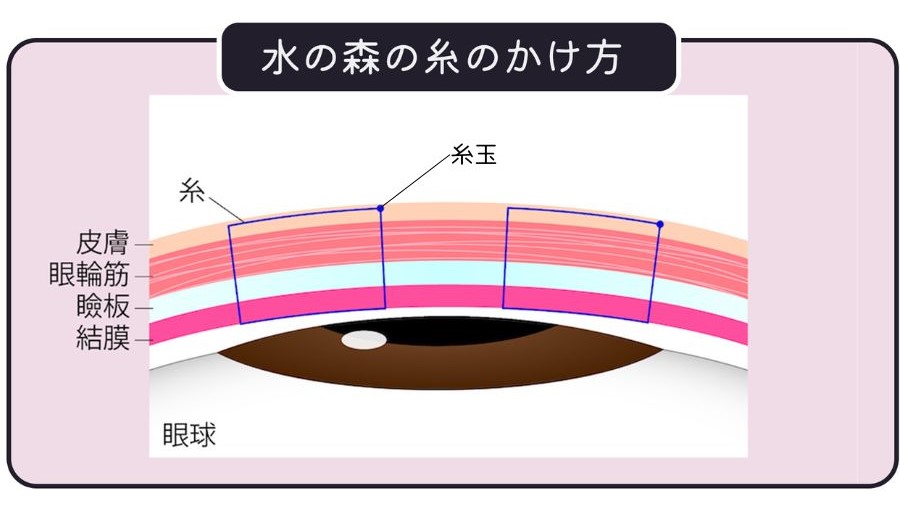 二重埋没法の表留め