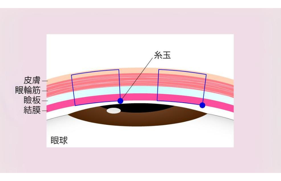 二重埋没法の裏留め