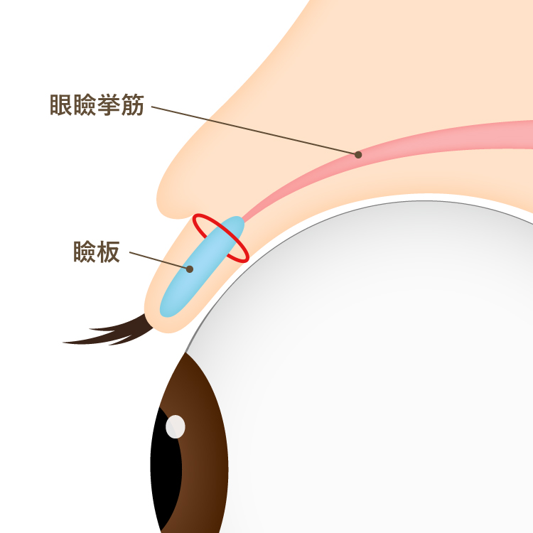 瞼板法