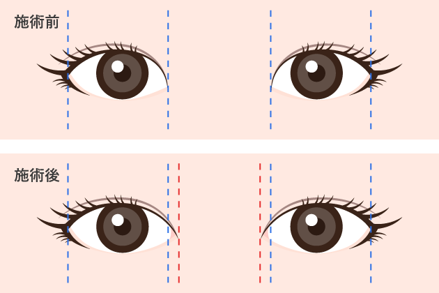 目頭切開法の術前後の変化の図