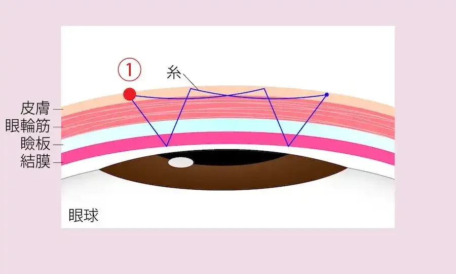 高額なプランの糸のかけ方の例