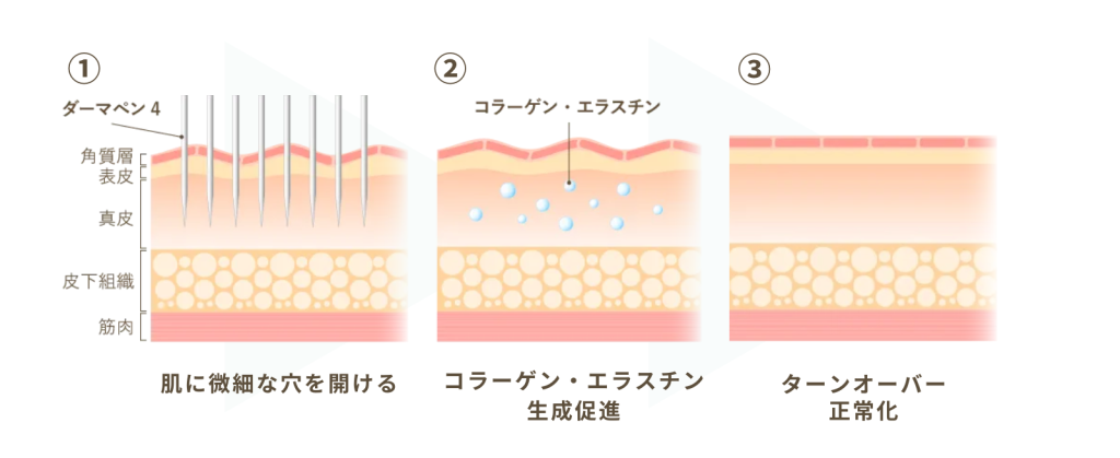 ダーマペンの効果