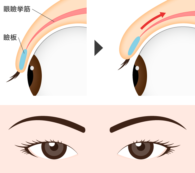 一重瞼の仕組み