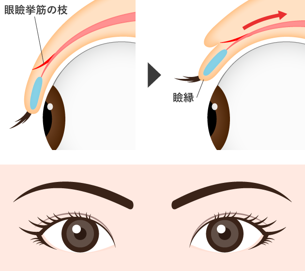 二重瞼の仕組み