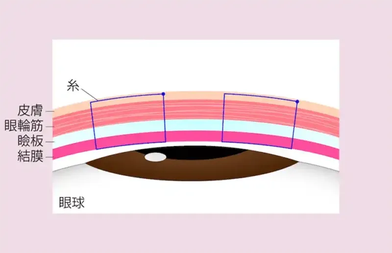 二重埋没法の施術方法