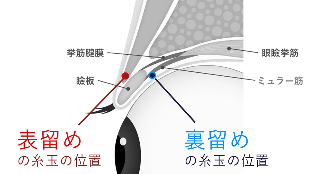 表留めと裏留めの違い