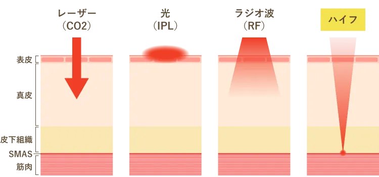 ハイフとその他治療の照射深度の違い