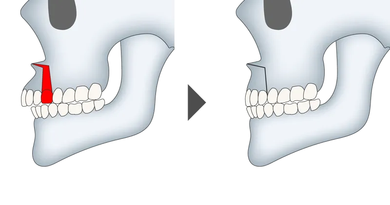 上顎セットバック整形の施術方法