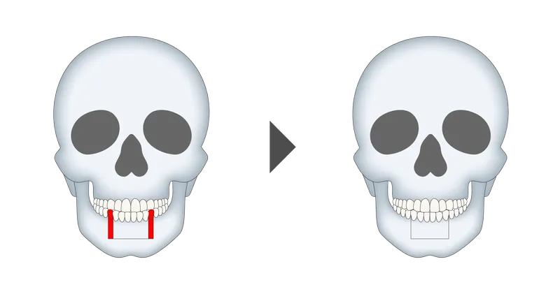 下顎セットバック整形