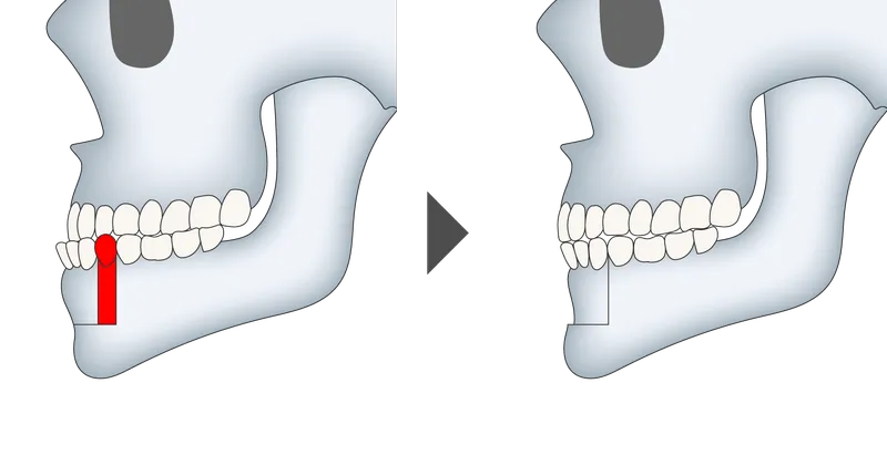 下顎セットバック整形の施術方法