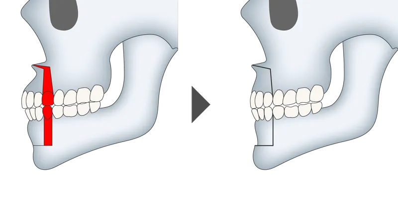 上下顎セットバックの施術方法