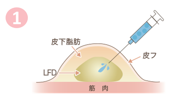 リサーフェイシング法 痩身 脂肪吸引 整形 美容整形なら水の森美容外科 公式 総合サイト