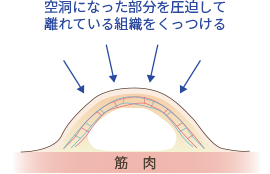 二の腕の脂肪吸引 症例写真と施術 脂肪吸引 痩身 整形 美容整形なら水の森美容外科 公式 総合サイト