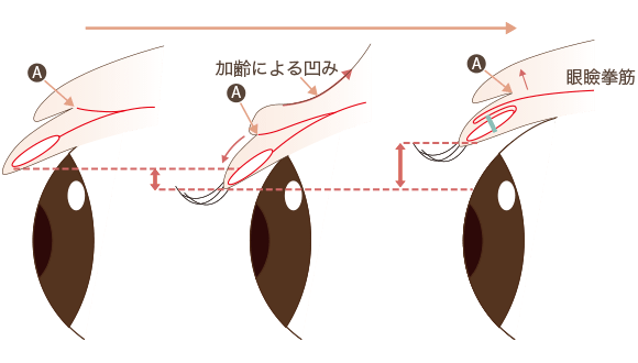 眼瞼下垂の整形について 目 二重 整形 美容整形なら水の森美容外科 公式 総合サイト