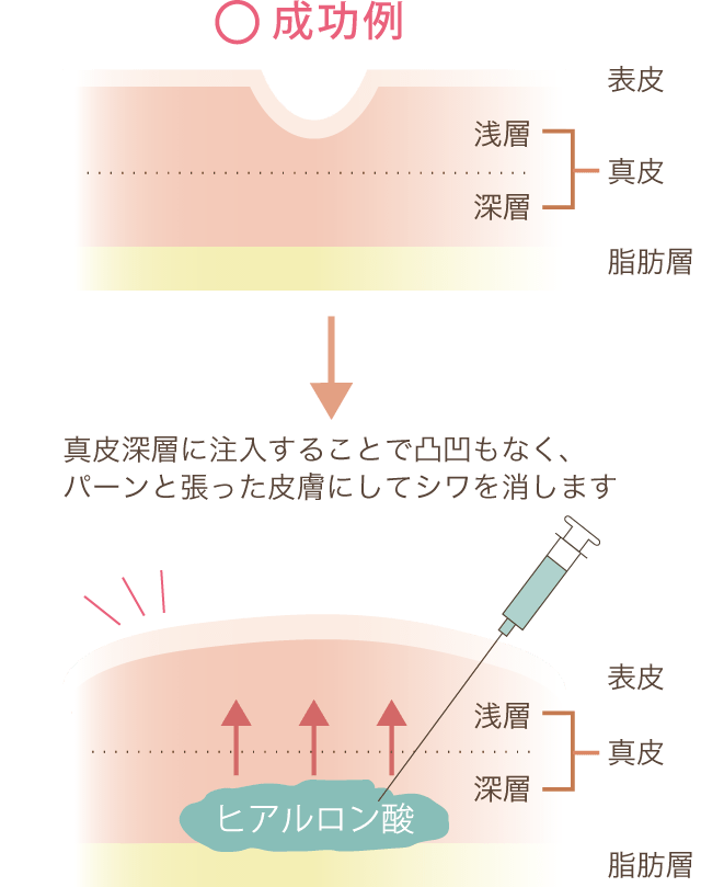 ほうれい線へのヒアルロン酸注入 美容整形なら水の森美容外科