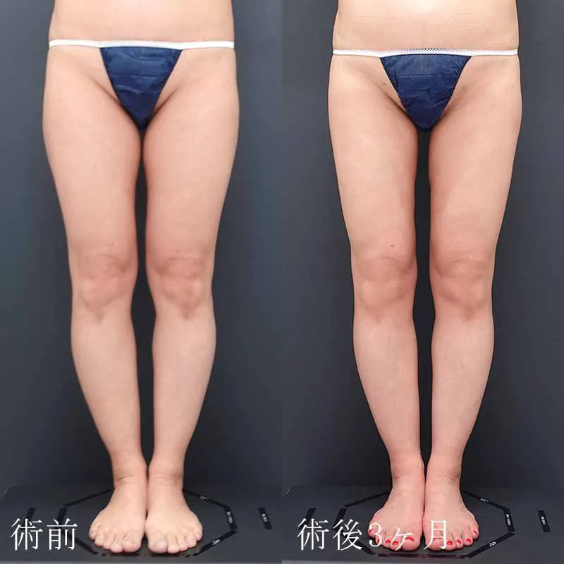 太もも・お尻の脂肪吸引の症例写真