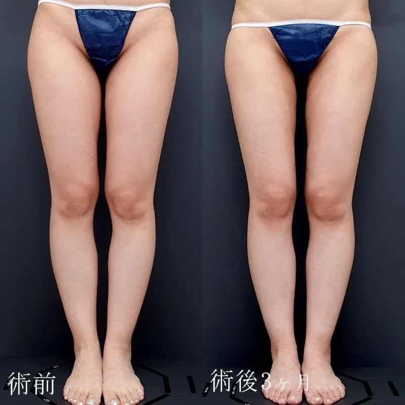 太もも・お尻の脂肪吸引の症例写真