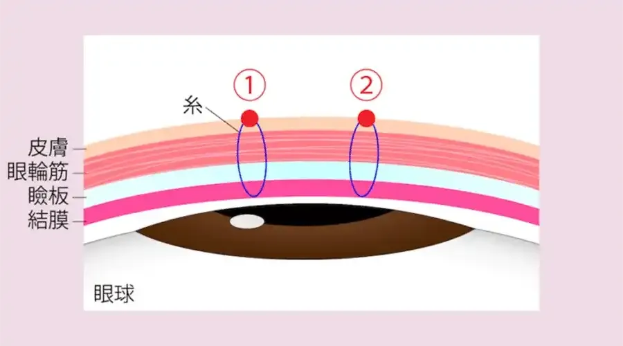 1本あたりの幅が極端に狭い2点留め