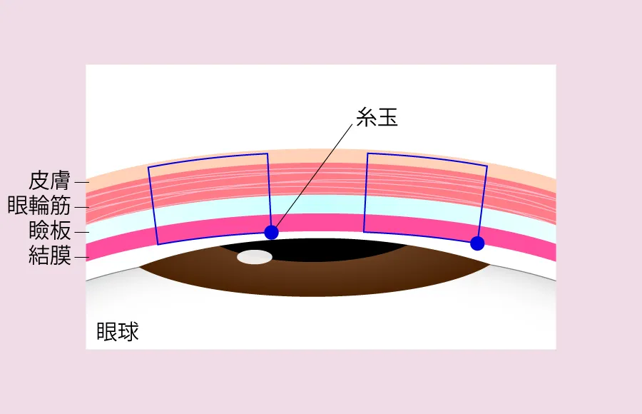 裏留め