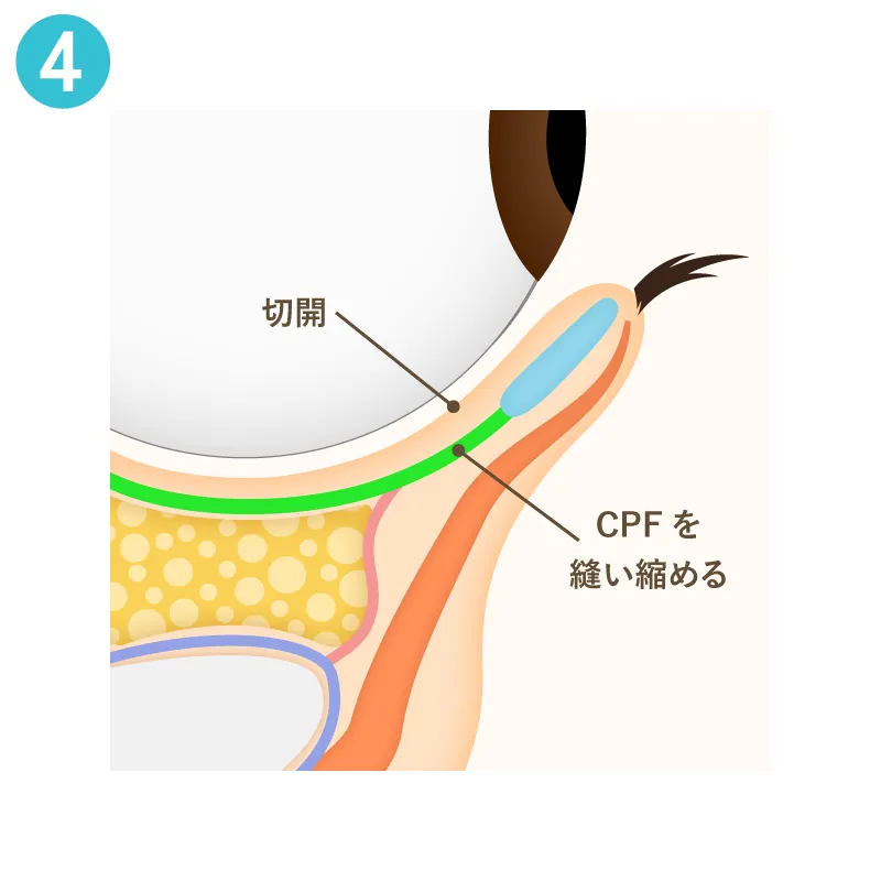 まぶたの裏側からの処置