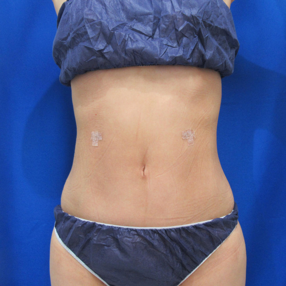 年10月1日 脂肪吸引 上 下腹部 ウエスト 腰 症例写真 美容整形 美容外科なら水の森美容外科 公式 総合サイト