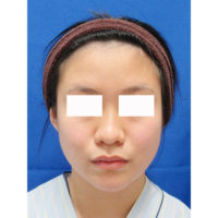 頬 顎など顔の脂肪吸引について 美容整形 美容外科なら水の森美容外科 公式 総合サイト