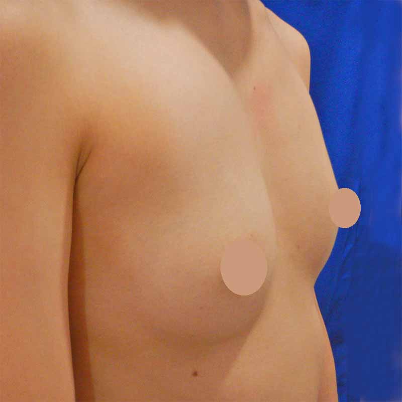 Breast augmentation_術前