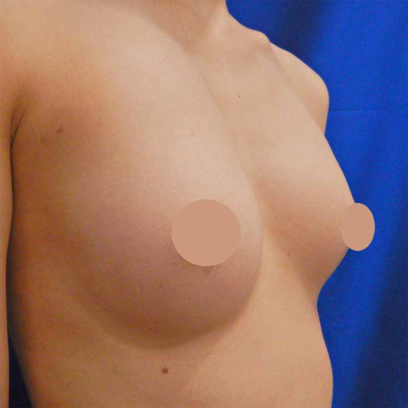 Breast augmentation_術後１ヶ月