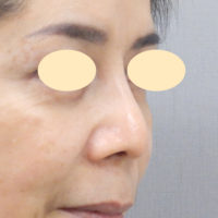 鼻尖縮小 だんご鼻 団子鼻修正 の整形について 美容整形 美容外科なら水の森美容外科 公式 総合サイト