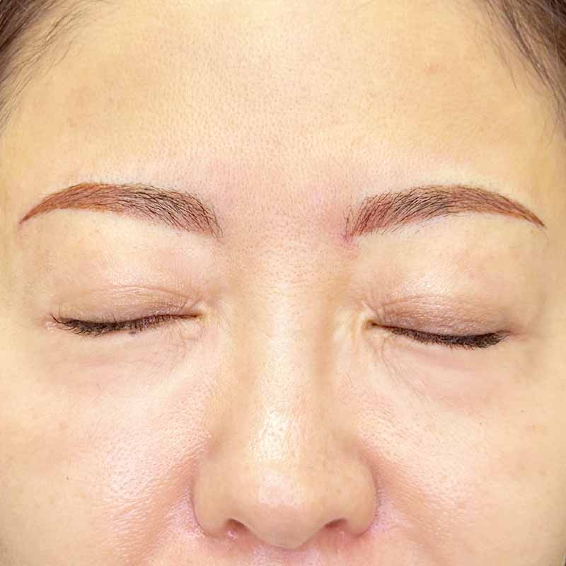 20230702_artmake_eyebrow_W_part 追加写真2回目術直後