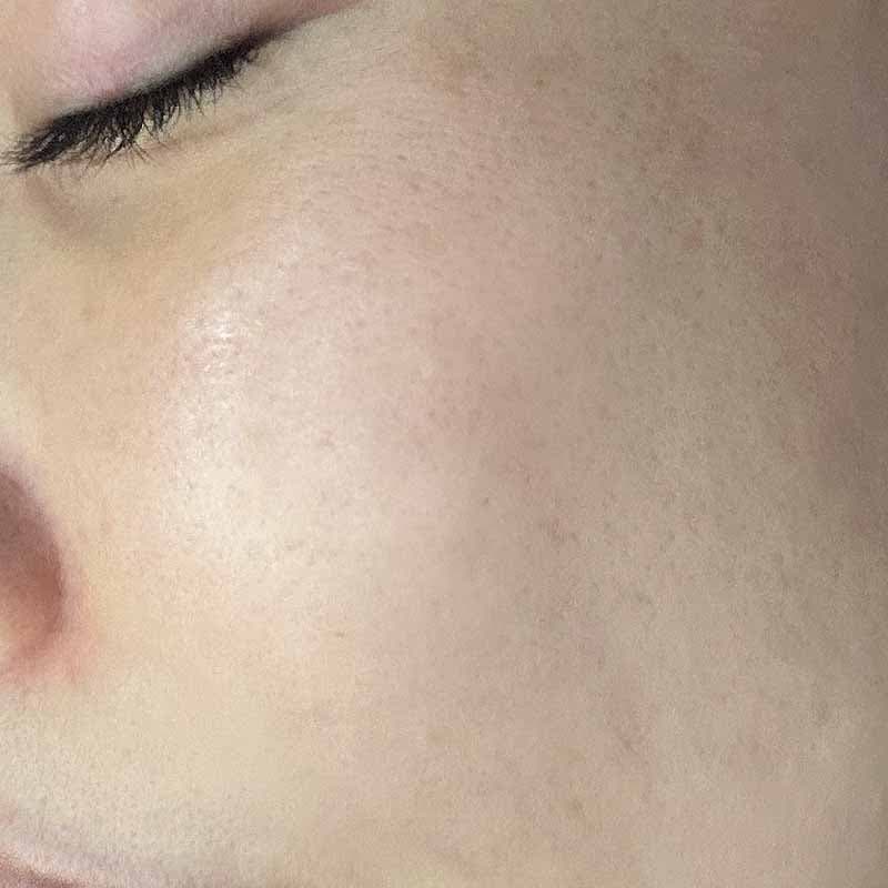 20230917_S0917_retinol-peel 追加写真①After