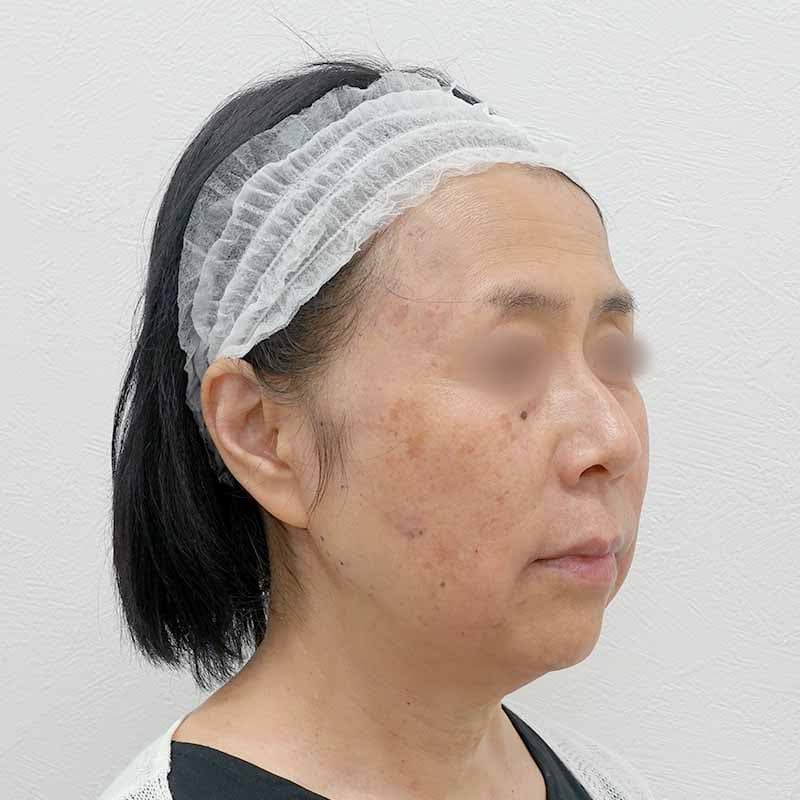 20240519_G34480_tukahara_hyaluronic acid lift02②After