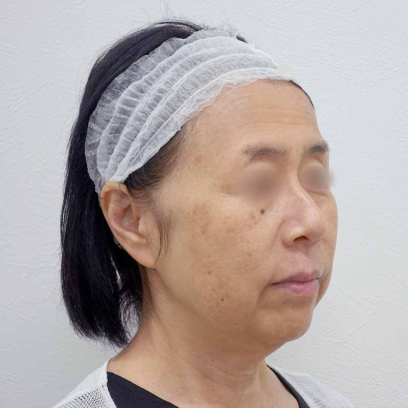 20240519_G34480_tukahara_hyaluronic acid lift02②Before