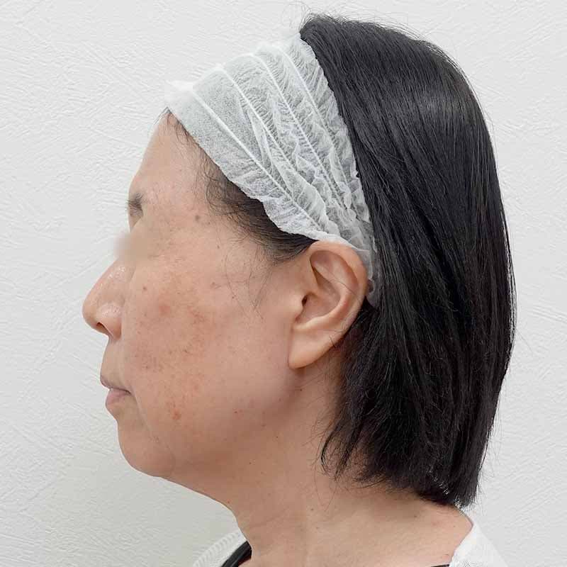 20240519_G34480_tukahara_hyaluronic acid lift02③After