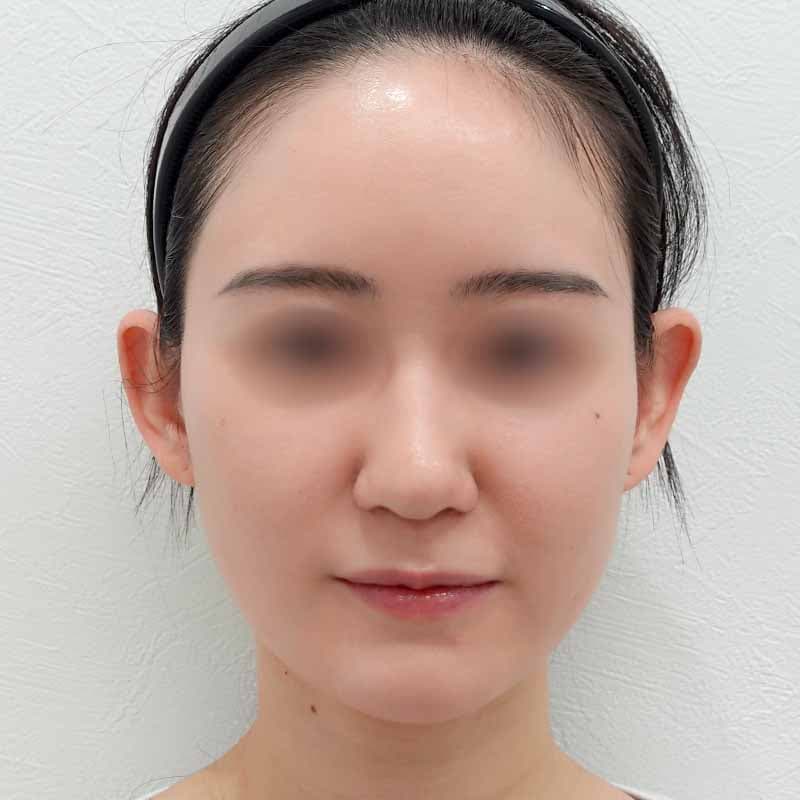 20240628_S20240628_osada_hyaluronic nose 1①Before