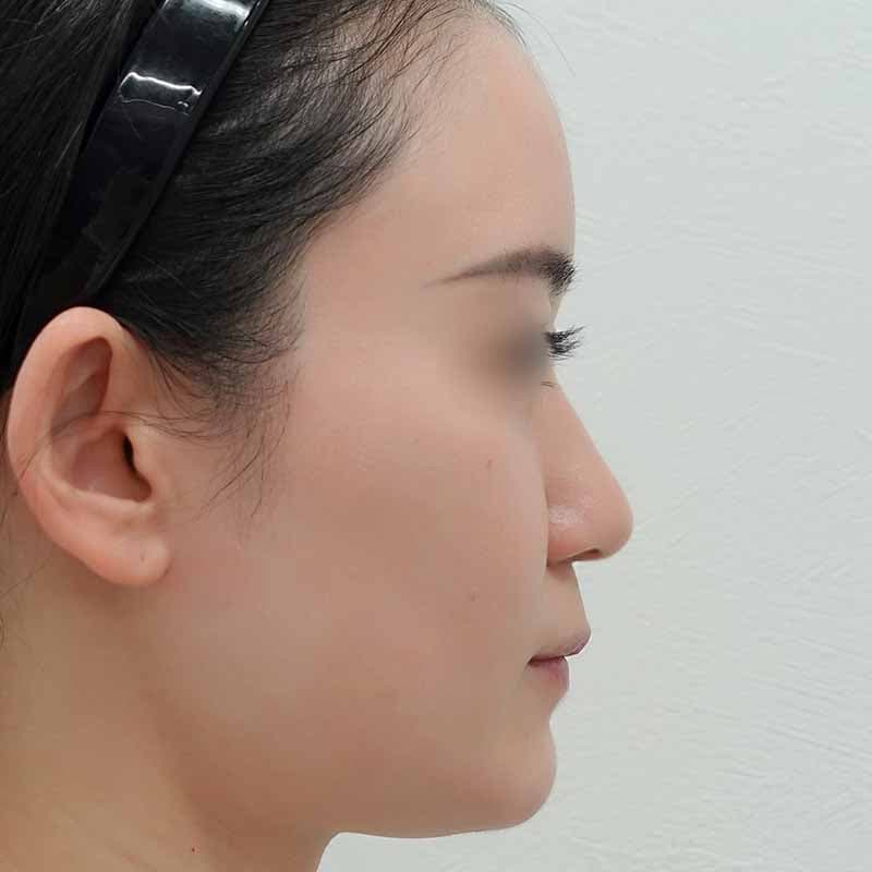 20240628_S20240628_osada_hyaluronic nose 1②Before