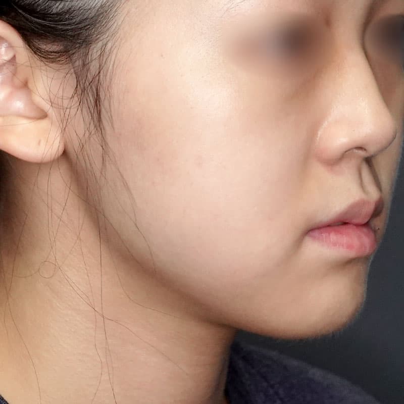 20240727_G32368_ishihara_face-liposuction_philtrum-botox①Before