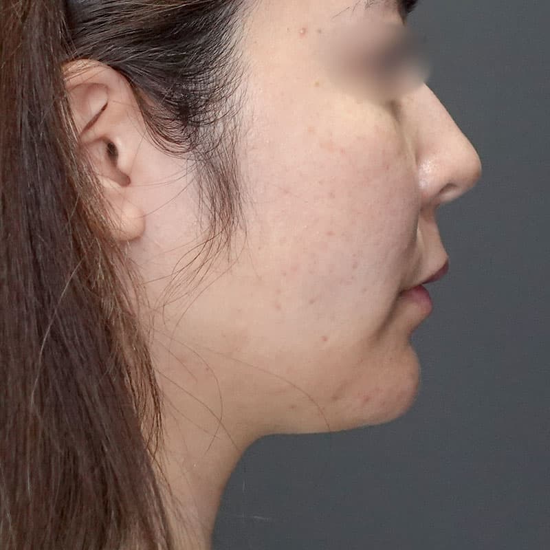 20240727_G35181_ishihara_face-liposuction_philtrum-botox①After