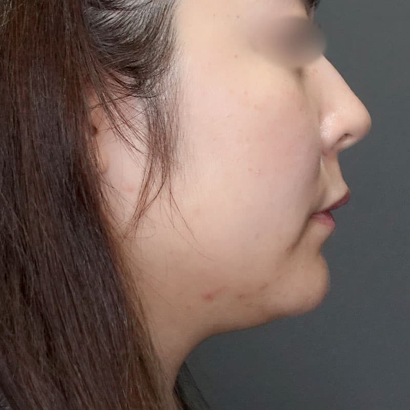 20240727_G35181_ishihara_face-liposuction_philtrum-botox①Before